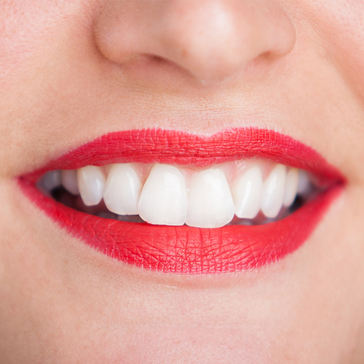 Mund mit gebleachten Zähnen - Bleaching bei Zahnarzt Freiburg mundharmonie Zahngesundheit